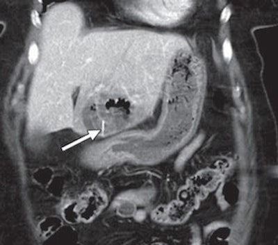 liver CT scan bristle