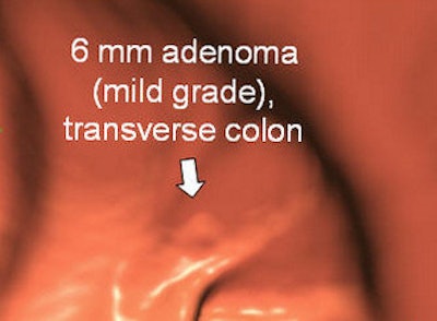 True-positive CAD detections included a 6-mm flat adenoma in the ascending colon