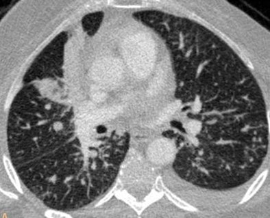 Axial CT pulmonary angiography image