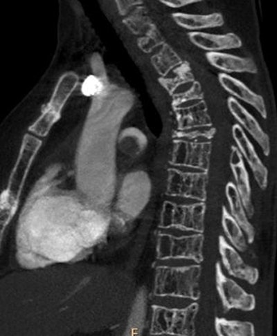 Sagittal CT pulmonary angiography image