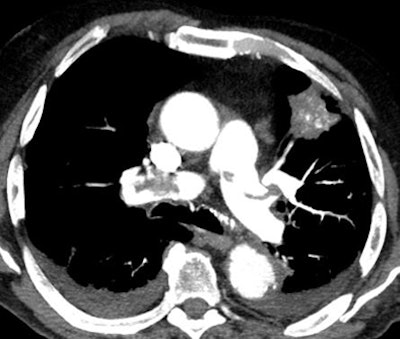 Axial CT pulmonary angiography image
