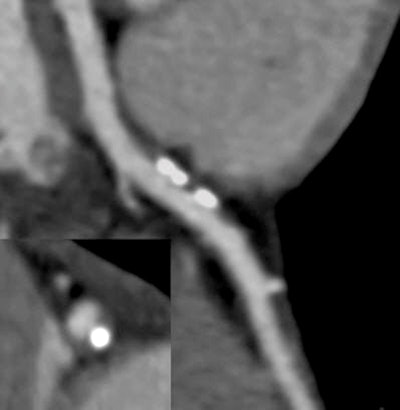 Coronary CT angiography in cocaine user