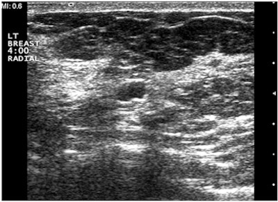 Solid mass requiring vacuum-assisted US-guided biopsy