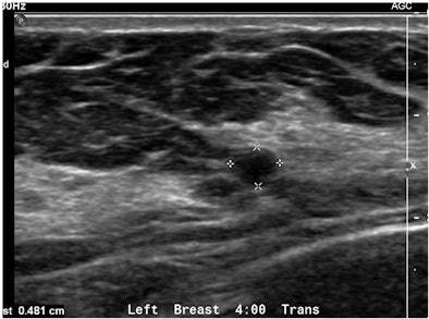 Solid mass requiring vacuum-assisted US-guided biopsy
