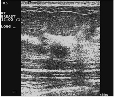 Deterioration with use of spatial compounding in ultrasound
