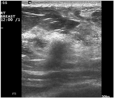 Deterioration with use of spatial compounding in ultrasound