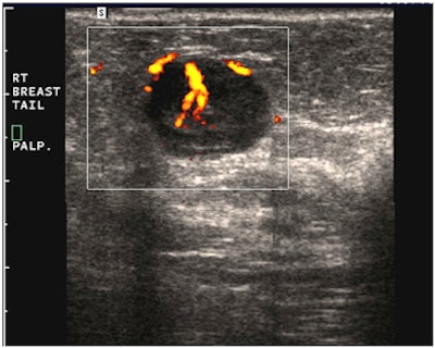 Ultrasound of circumscribed round pseudocystic mass