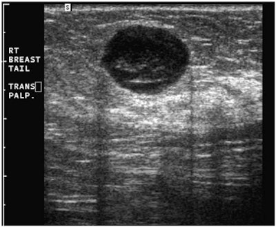 Ultrasound of circumscribed round pseudocystic mass