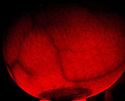 Breast transilluminators