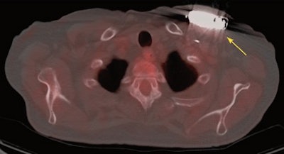 PET/CT shows abnormal FDG uptake posterior to IED generator