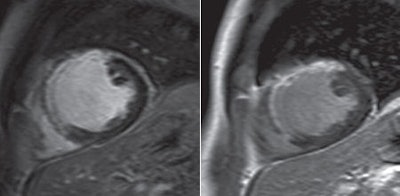 Gadopentetate and gadobutrol cardiac MRI