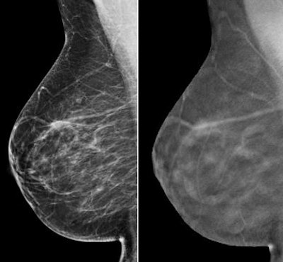 2D versus tomosynthesis view of right breast