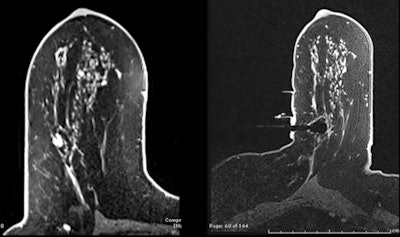 2012 05 04 15 55 28 920 Vashi Slide2 Mri Breast 450