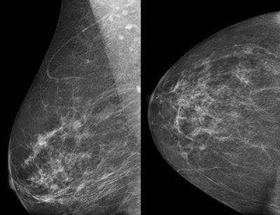 2012 05 04 15 55 30 758 Vashi Slide1 Mri Breast 450