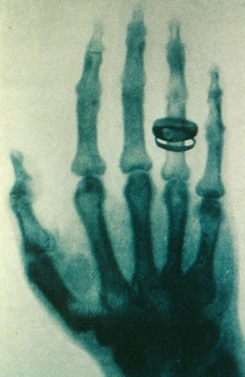 One of Roentgen's early images.