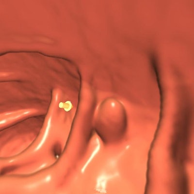 3D endoluminal view in patient with no laxatives used
