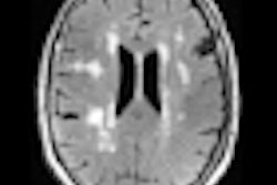 2012 05 15 15 07 55 247 White Matter Hyperintensity 70