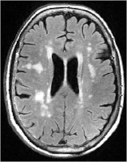 White-matter hyperintensities are commonly seen on MRI of elderly subjects. Image courtesy of Dr. Lisa Silbert.