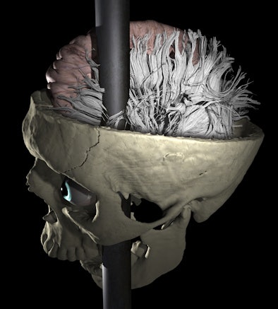 Location of rod through Phineas Gage's skull