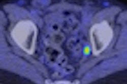 2012 05 23 08 54 56 520 Choline Pet Ct Karnes Thumb