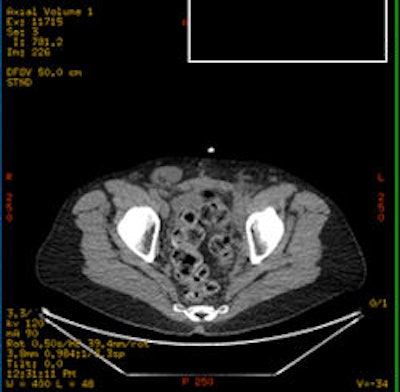 PET/CT of the pelvis