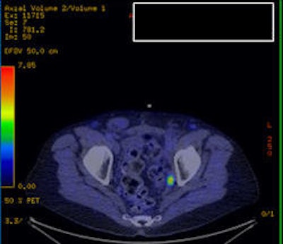 Choline-PET/CT of the pelvis