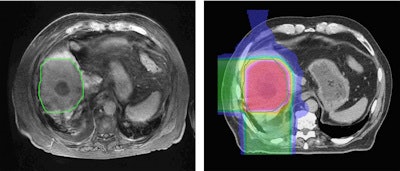Left: MR image taken 2.5 months after five-fraction proton therapy. Right: The corresponding planned dose distribution. Image courtesy of Thomas Bortfeld, PhD.