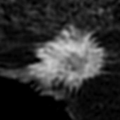 MRI shows spiculated lesion