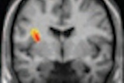 2012 06 04 16 43 58 992 F Mri Post Stroke Despression Thumb