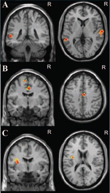 Correlation between functional connectivity and severity of early anxiety at fMRI