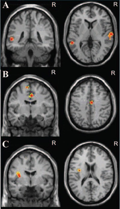 Correlation between functional connectivity and severity of early anxiety at fMRI