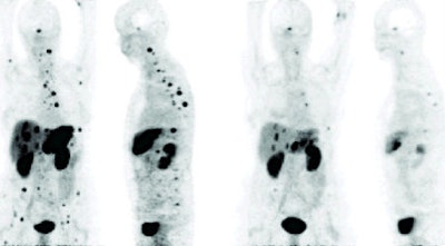 Response to Bi-123 DOTANOC treatment