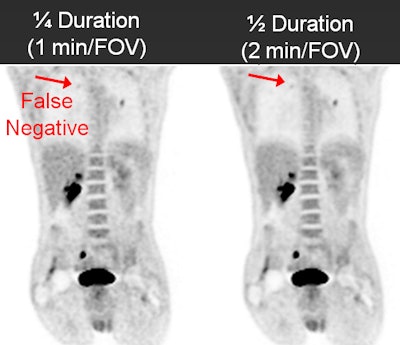 False negative on FDG-PET