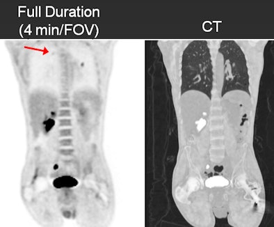 False negative on FDG-PET