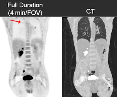 False negative on FDG-PET
