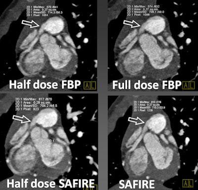 Iterative reconstruction series