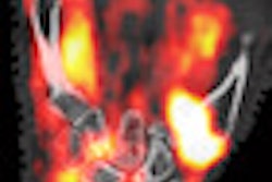 2012 06 21 15 30 30 40 Petct Rheumatoid S6 Thumb