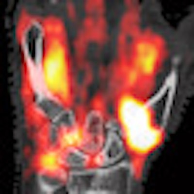 2012 06 21 15 30 30 40 Petct Rheumatoid S6 Thumb