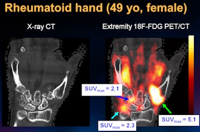 Hand of a female patient with rheumatoid arthritis