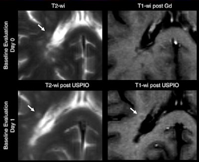 MRI of 49-year-old woman with multiple sclerosis