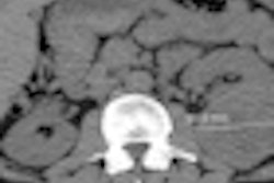 2012 06 25 15 42 37 817 Saghir Ct Lung Thumb