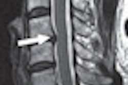 2012 07 05 13 57 23 737 Kang Cervical Canal Stenosis Thumb