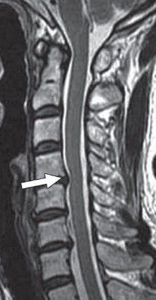 Woman with cervical canal stenosis