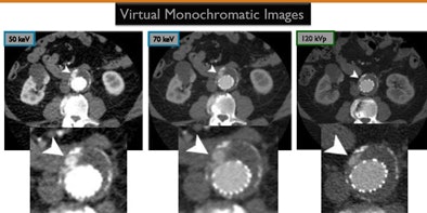 Higher vascular attenuation