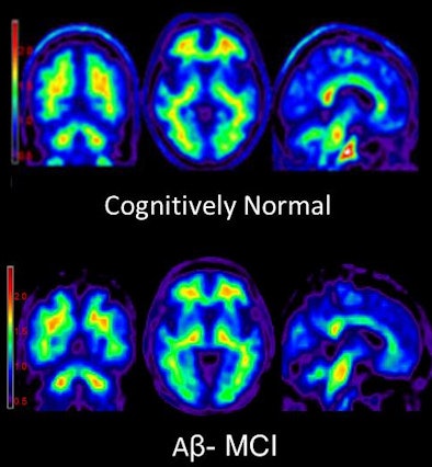 Florbetapir-PET images of beta-amyloid plaque