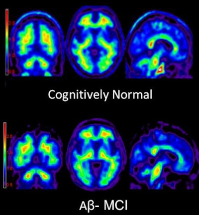 Florbetapir-PET images of beta-amyloid plaque