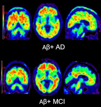 Florbetapir-PET images of beta-amyloid plaque