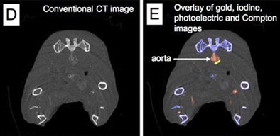 CT image near bifurcation of aorta