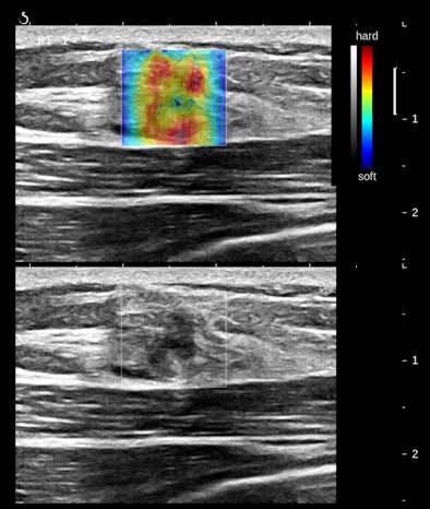 Follicular neoplasm of the thyroid on ultrasound