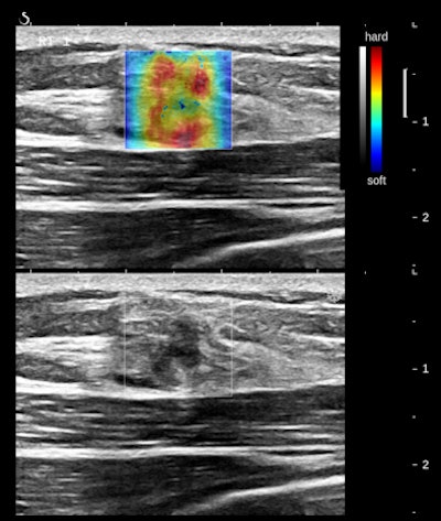 Follicular neoplasm of the thyroid on ultrasound